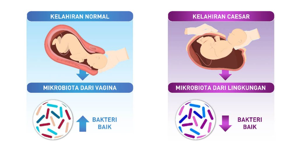 imunitas anak kelahiran caesar