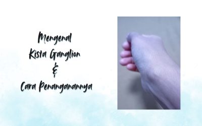 Apa itu Kista Ganglion dan Cara Penanganannya