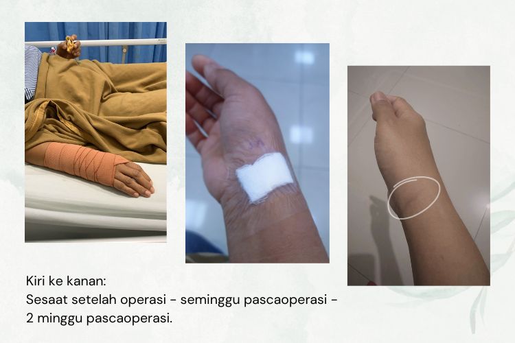 Penanganan kista ganglion