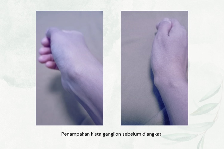 kista ganglion pergelangan tangan